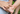 best vitiligo treatment cream, Hypopigmentation cream usage