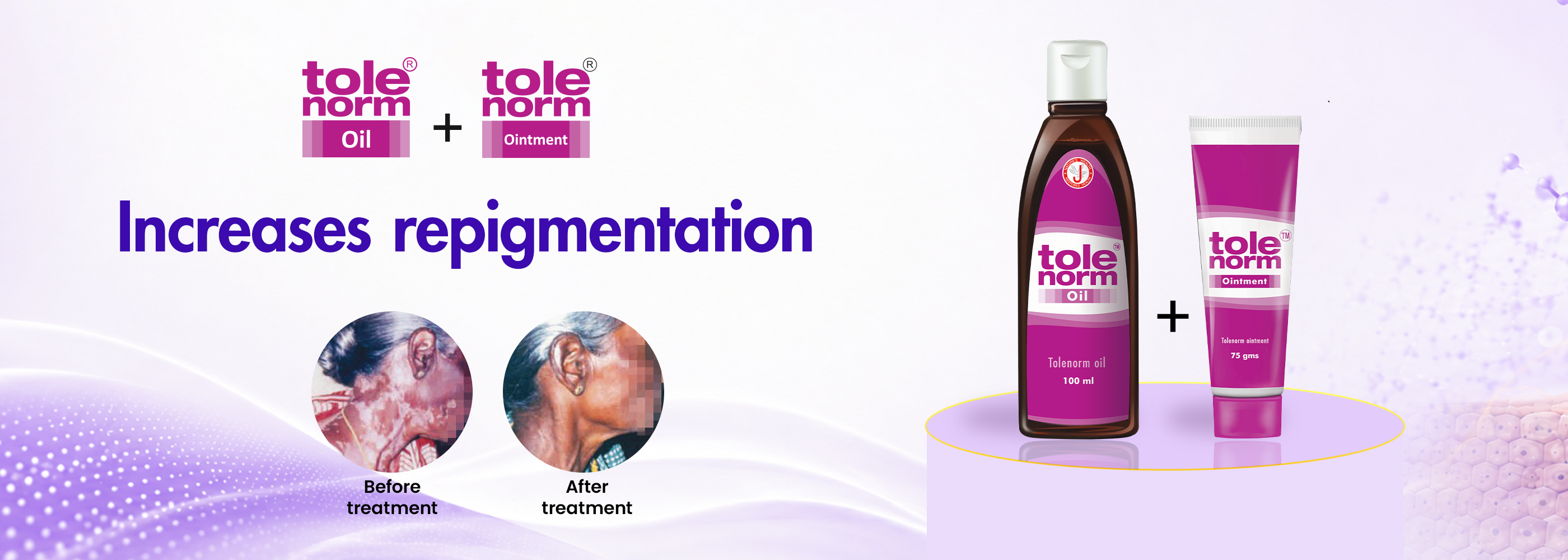 Best vitiligo treatment products