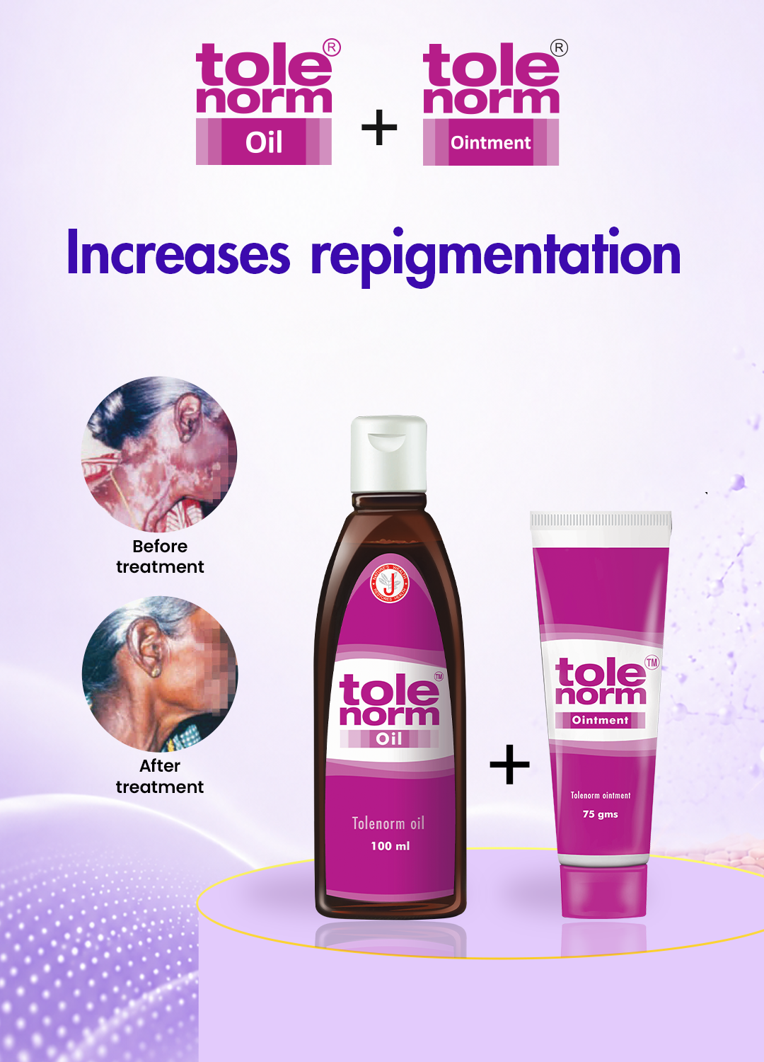 Best vitiligo treatment products